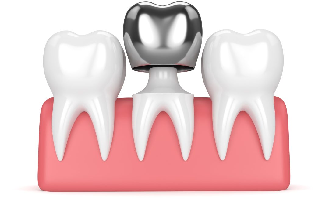 Metal Crown: Is It the Right Choice?