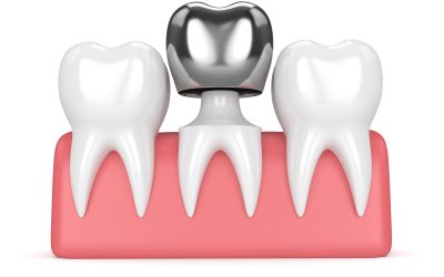 Metal Crown: Is It the Right Choice?