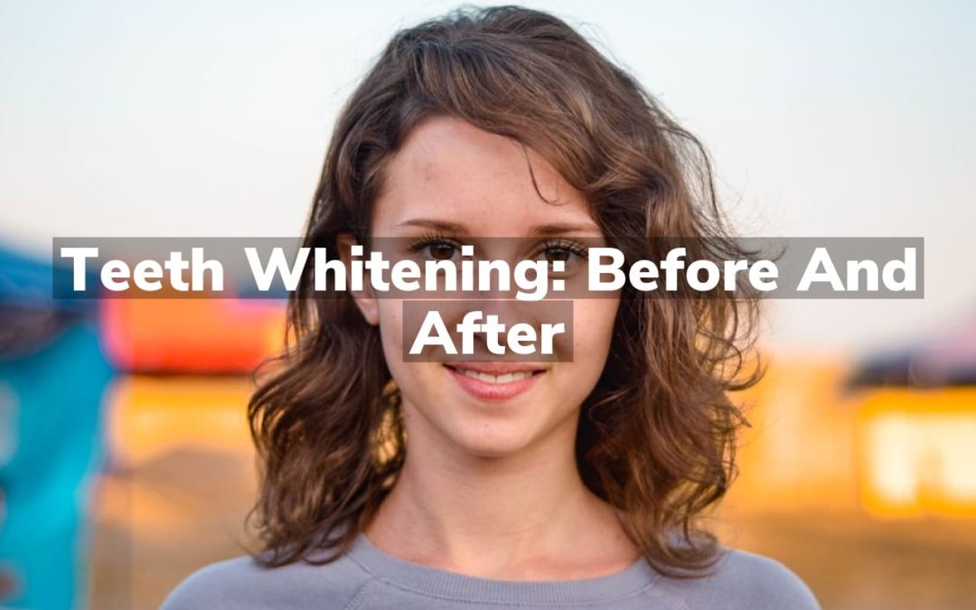 Teeth Whitening: Before and After